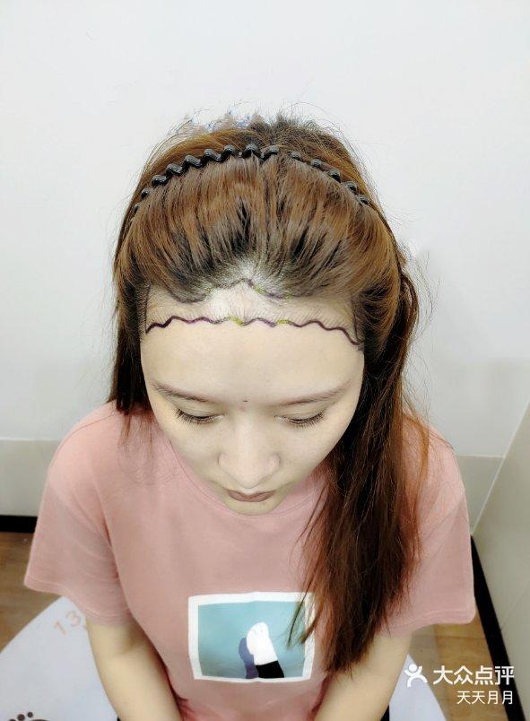 女生可以植发吗(女生可以植发吗有危险吗)