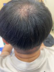 -大麦微针植发全国连锁
