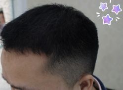 -大麦微针植发丨全国连锁