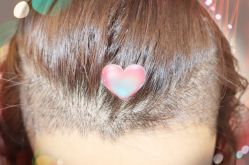 -大麦微针植发全国连锁