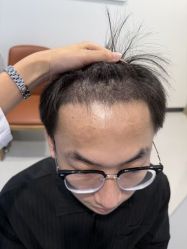 -大麦微针植发全国连锁
