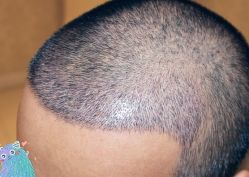 -大麦微针植发丨全国连锁