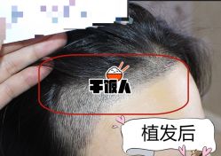 -大麦微针植发全国连锁