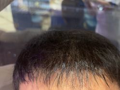 -碧莲盛·不剃发植发