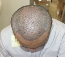 -大麦微针植发全国连锁