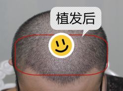 -大麦微针植发全国连锁