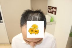 -大麦微针植发丨全国连锁