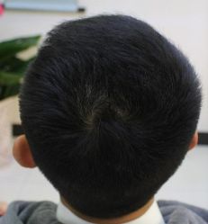 -大麦微针植发丨全国连锁