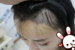 -大麦微针植发丨全国连锁