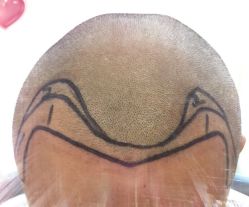 -大麦微针植发全国连锁