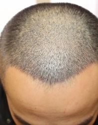 -大麦微针植发丨全国连锁