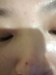 -美人痣全国连锁