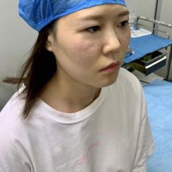 点击看大图 体验后-广州健丽·去眼袋医疗美容机构