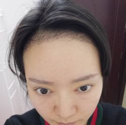 -碧莲盛·不剃发植发