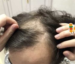 -大麦微针植发全国连锁