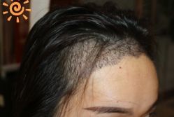 -大麦微针植发丨全国连锁