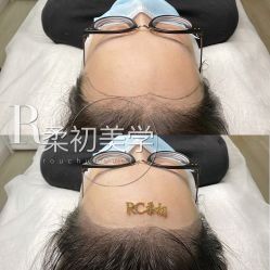 -RC半永久纹眉纹发际线