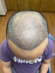 -大麦微针植发全国连锁