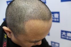 -大麦微针植发丨全国连锁