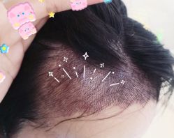 -大麦微针植发全国连锁