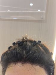 -碧莲盛不剃发植发