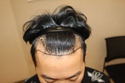 -大麦微针植发丨全国连锁