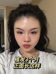 -碧莲盛·不剃发植发