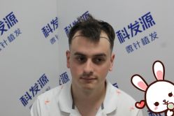 点击看大图 -大麦微针植发丨全国连锁