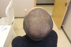 -大麦微针植发丨全国连锁