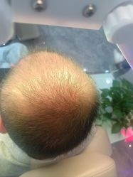 -碧莲盛·不剃发植发