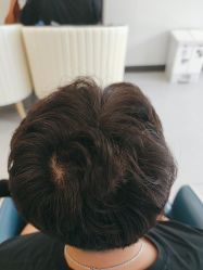 -大麦微针植发全国连锁