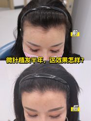 -大麦微针植发全国连锁