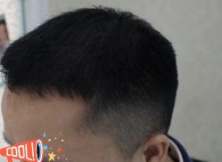 -大麦微针植发丨全国连锁