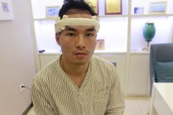 -大麦微针植发丨全国连锁