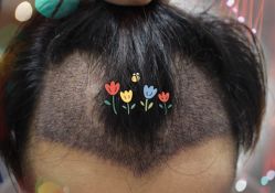 -大麦微针植发全国连锁