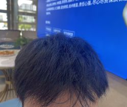 -碧莲盛·不剃发植发