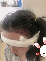 点击看大图 -大麦微针植发丨全国连锁