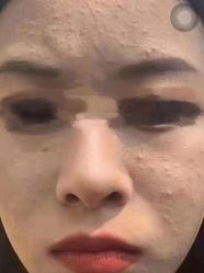 -苗方清颜专业祛痘连锁机构
