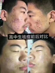 -瑶芳清颜草本祛痘