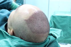 点击看大图 -大麦微针植发丨全国连锁