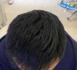 -大麦微针植发丨全国连锁