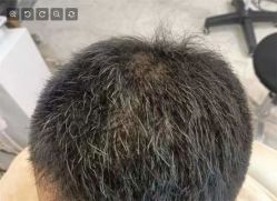 -大麦微针植发丨全国连锁