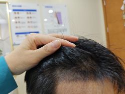 -碧莲盛·不剃发植发