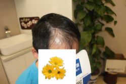 -大麦微针植发丨全国连锁
