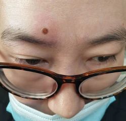 -北京美痣堂古方祛痣斑疣瘊