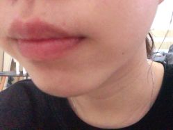 体验后-深圳春天阳光医院·轮廓抗衰中心