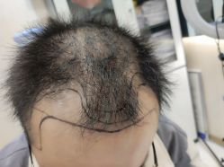 体验前-碧莲盛·不剃发植发