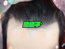 -大麦微针植发全国连锁