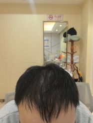 -碧莲盛·不剃发植发