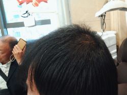 -碧莲盛·不剃发植发